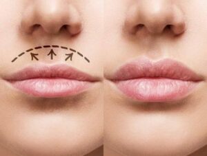 Plasma Lip Lift – Aναπλήρωση Όγκου Χειλιών