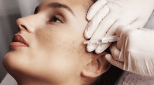 Skin Boosters: Μεσοθεραπεία με Υαλουρονικό Οξύ